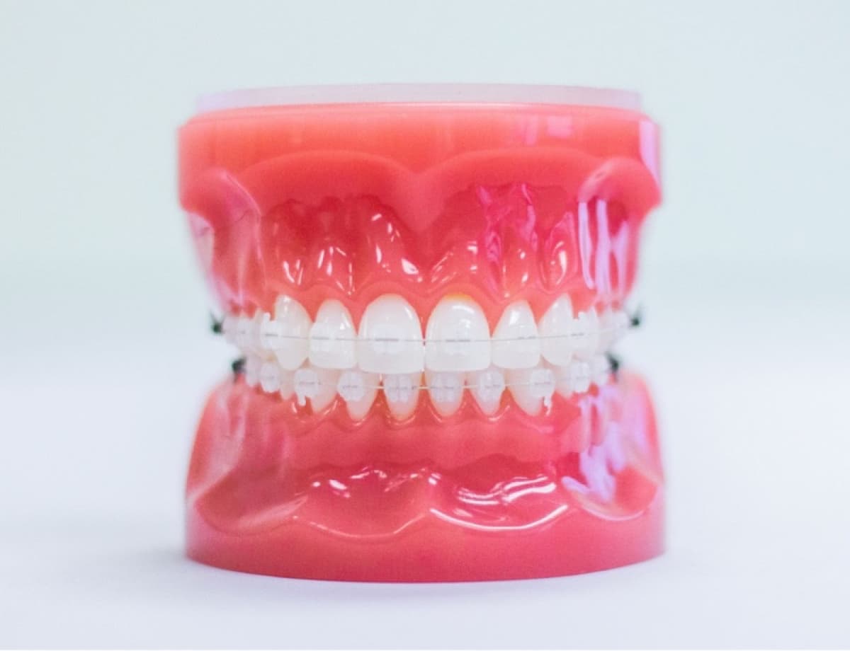 clear braces on plastic model